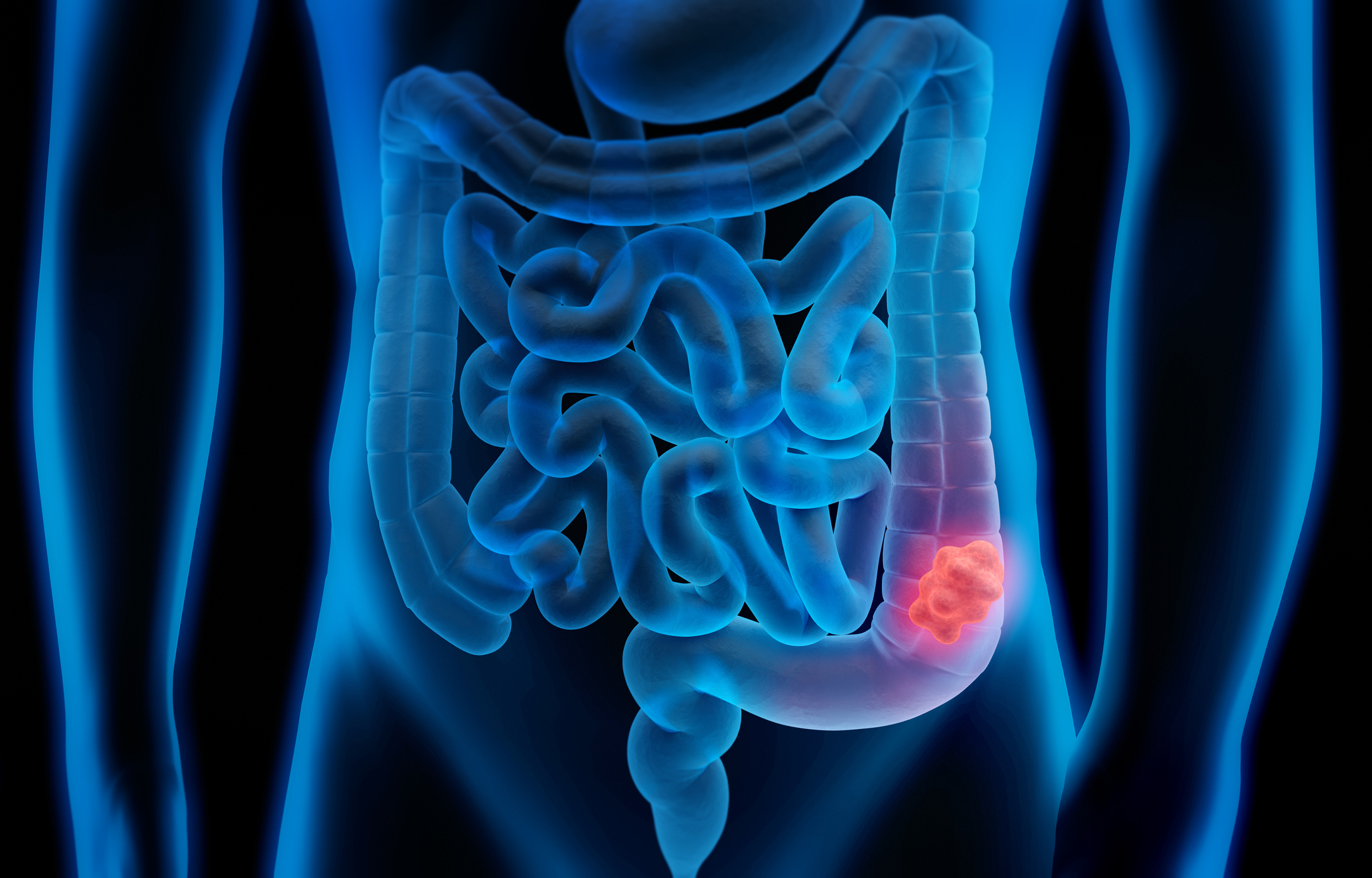 colon-cancer-condition-uams-health