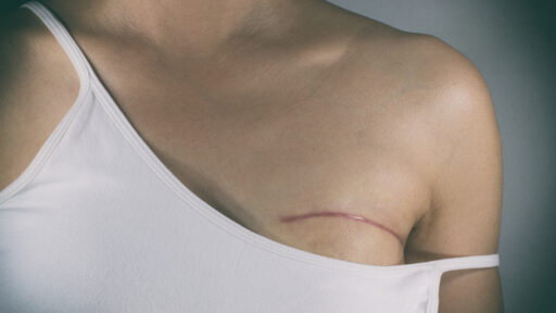 a woman showing her breast surgery