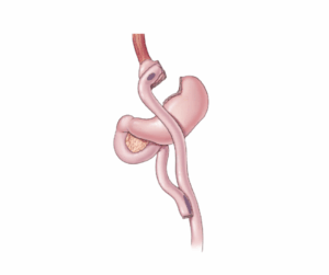 Roux-en-Y Gastric Bypass
