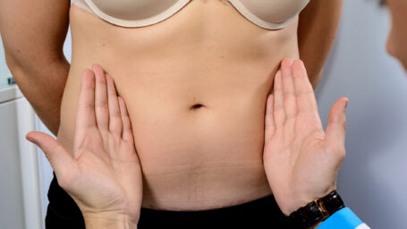 Consultation for a tummy tuck