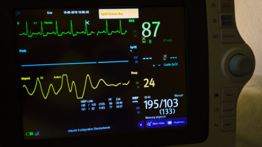ECG with high blood pressure and high heart rate
