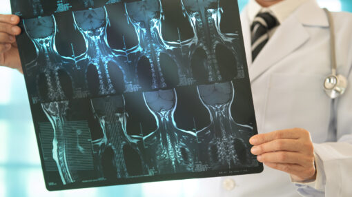 Orthopedic surgeons or Orthopedic surgery doctor check x-ray images of Cervical spondylosis for diagnose orthopedics, thyroid cancer,spine diseases.
